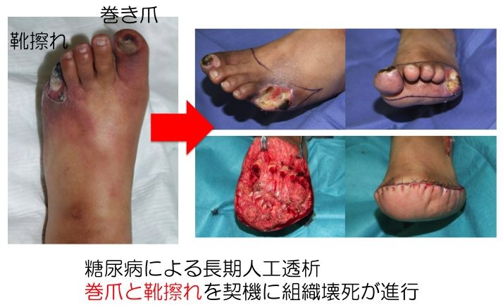 糖尿病の食事療法