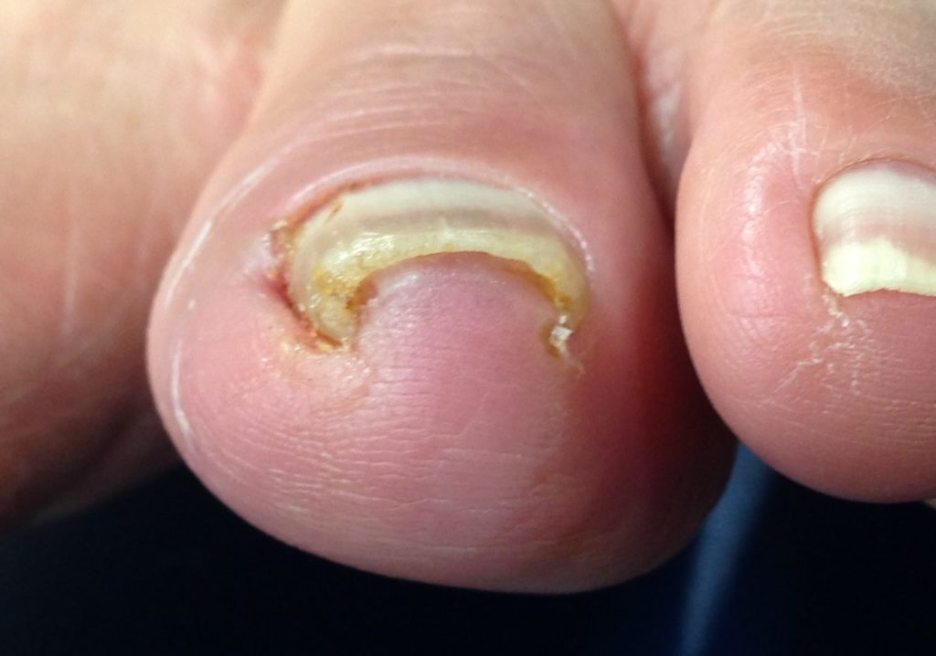 足の爪が元に戻るまでどれくらいかかりますか?